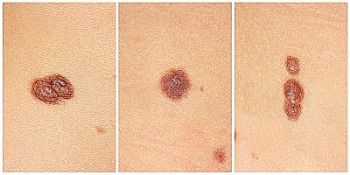 melanoma symptoms