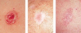 kinds of skin cancer pictures